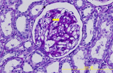 Diabetic Nephropathy and Chronic Kidney Disease Models