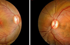 Diabetic Retinopathy